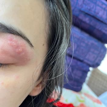 Mov Turkey Glitter Alerjisi