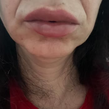 Maybelline Lifter Gloss Dudak Parlatıcısı Alerji Yaptı