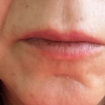 Maybelline Lifter Gloss Dudak Parlatıcısı Alerji Yaptı