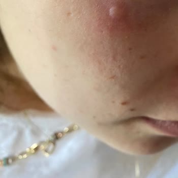 Sebamed Ürün Kaşıntı Kızarıklık Yanma Yaptı