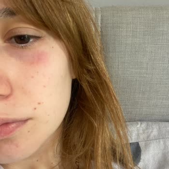 Sebamed Ürün Kaşıntı Kızarıklık Yanma Yaptı