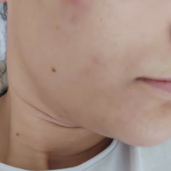 La Roche Posay Cıcaplast Baume B5+ Kremi İle İltihaplı Sivilce Problemim!