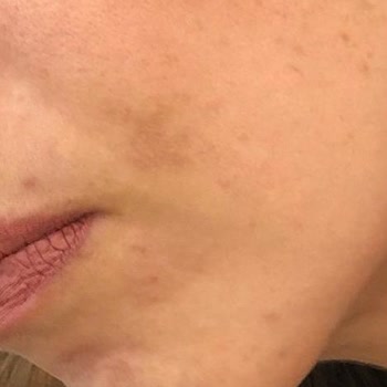 Selin Beste Kan Güzellik Most Bakım Pişmanlığı