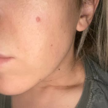 The Purest Solutions The Purest Solution Sivilce Yaptı