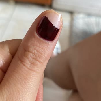 Aymira Koçaklı Yaşam Merkezi Protez Tırnak Sorunu