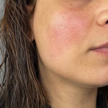 She Vec Cosmetic Alerjik Egzama Olmuş Yüzüm