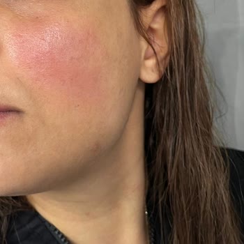 She Vec Cosmetic Alerjik Egzama Olmuş Yüzüm