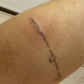 İvente Beauty Lazer Epilasyonda Dövmem Yakıldı