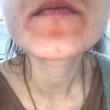 La Roche - Posay Ürünleri Yüzümde Yanık Oluşturdu