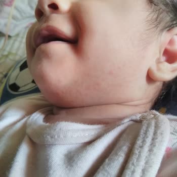 Dalin Şampuanının 6 Aylık Bebeğimde Oluşturduğu İsilik