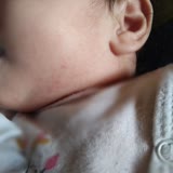 Dalin Şampuanının 6 Aylık Bebeğimde Oluşturduğu İsilik