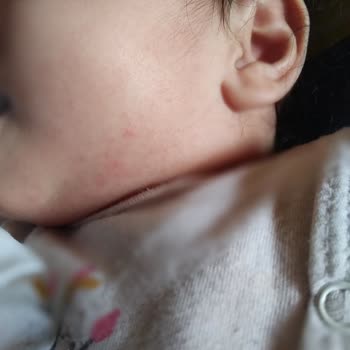 Dalin Şampuanının 6 Aylık Bebeğimde Oluşturduğu İsilik