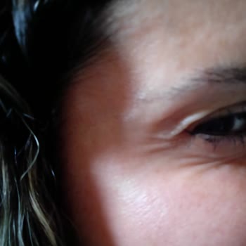 Dr. Hakan Tetik Botoks Uygulaması Sorunu