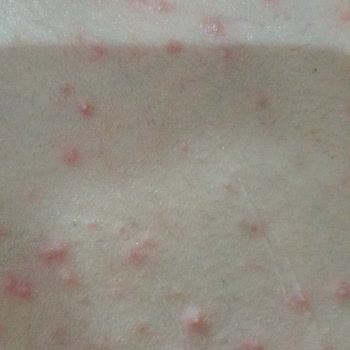 Herbaderm Leke Kremi Sivilce Benzeri Şeyler Oluşturdu