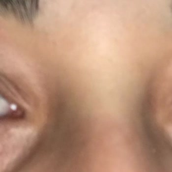 Arya Güzellik Salonu (Aydın) İpek Kirpik Şişlik Ve Kaşıntı