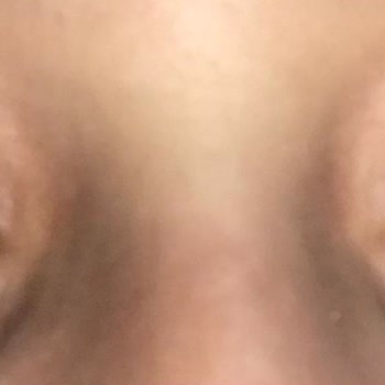 Arya Güzellik Salonu (Aydın) İpek Kirpik Şişlik Ve Kaşıntı