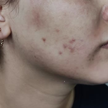 Ordu Dermatolog Dr. Derya Tekeş Qswich Lazer Yanığı Hüsranı!