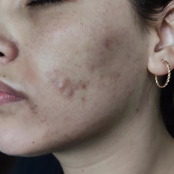 Ordu Dermatolog Dr. Derya Tekeş Qswich Lazer Yanığı Hüsranı!