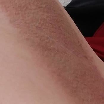 Driclor'un Yaptığı Tahriş Ve Kaşıntı Sonrası Kararma Olması