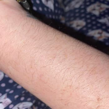 Asya Hastanesi Lazer Memnuniyetsizliği Ve İlgisizliği