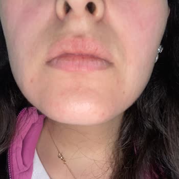 La Roche - Posay Ürünleri Kullanımı Sonrası Yüzümde Kızarıklık Ve Şişlikler Oluştu