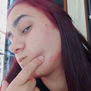 Newgen Serumlar Sivilceye Sebep Oldu