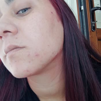 Newgen Serumlar Sivilceye Sebep Oldu