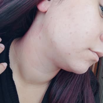 Newgen Serumlar Sivilceye Sebep Oldu