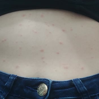 Supra Protein Alerji Yaptı Hastanelik Oldum