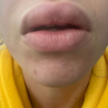 Tuğçe Aktaş Beauty Center Dudak Dolgusu Şikayetim