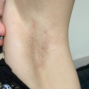 Driclor Koltuk Altımdaki Deriyi Yaktı