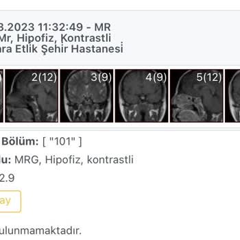 Ankara Etlik Şehir Hastanesi MR Sonucum Çok Gecikti