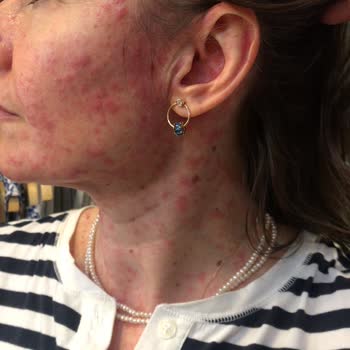 Abdi İbrahim Factive İlaç Alerjisi