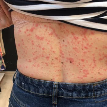 Abdi İbrahim Factive İlaç Alerjisi