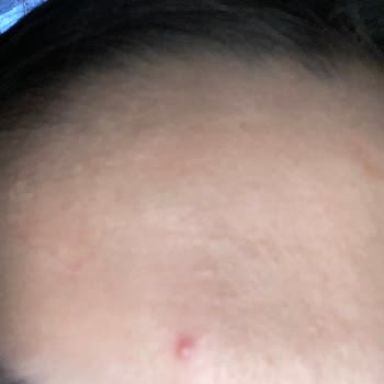 Neutrogena Hydro Boost Sivilce Yaptı