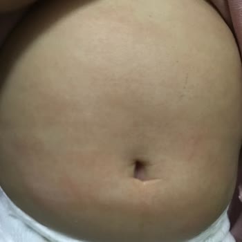 Mustela Stelatopia Kremi Bebeğimin Vücudunu Mahvetti