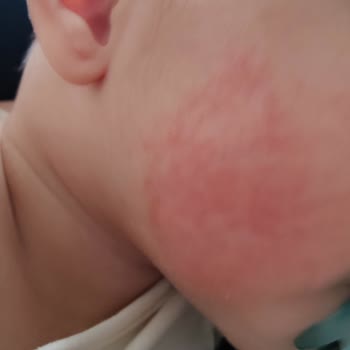 Mustela Cilt Alerjisi Yaptı!