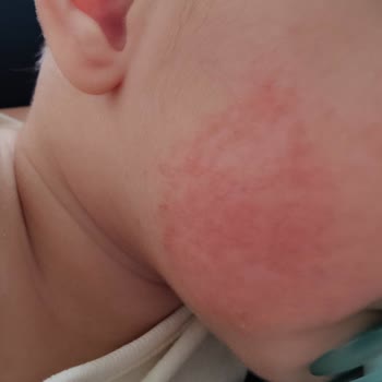 Mustela Cilt Alerjisi Yaptı!