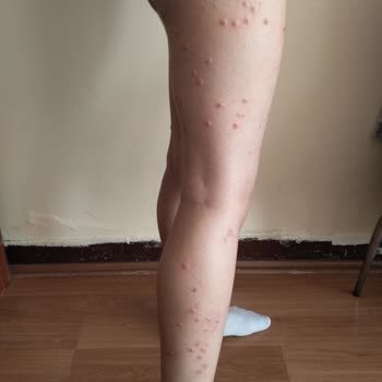 Rosida Park Estetik Hijyensizlikten Başkasının Hastalık Bulaştı