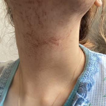 Özel Art Polikliniği Yüz Bölgesinde Ciddi Yanıklar