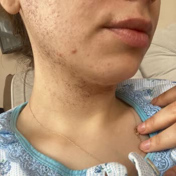 Özel Art Polikliniği Yüz Bölgesinde Ciddi Yanıklar