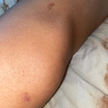 Merve İlk Güzellik Salonu Lazerden Ayağımı Yaktılar