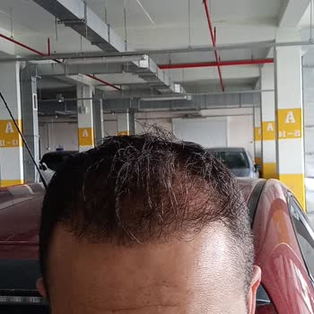 Estetik International Hastanesi Bursa, Saç Ekimi Ve Revizyon