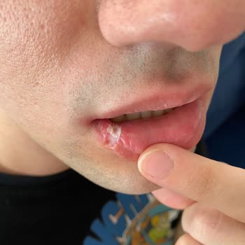 Medical Park Hastanesi Pendik Diş Haksız Rakam Talebi, Oğlumun Dudağını Yakmaları