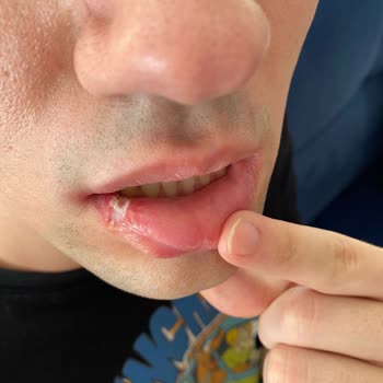 Medical Park Hastanesi Pendik Diş Haksız Rakam Talebi, Oğlumun Dudağını Yakmaları