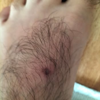 Koray Spor'dan Aldığım Adidas Spor Ayakkabısı Ayağımı Yaraladı