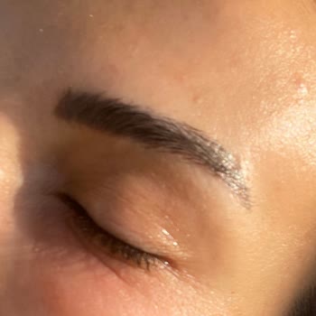 Duaderm Yanık Göz Çevresi