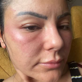 Duaderm Yanık Göz Çevresi