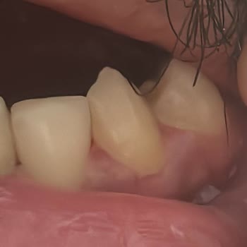 Dürümle Alanya Şubesi'nden Verdiğim Sipariş İçinden Taş Çıkması