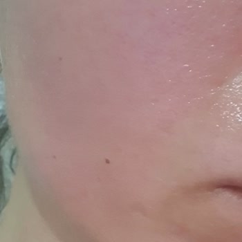 Neutrogena Canlandırıcı Peeling Jel Yüzde Alerji Yanma Yaptı